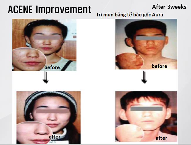 tế bào gốc ngăn ngừa và điều trị mụn aura hàn quốc